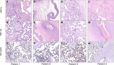 Targeted management of evolving and established chronic lung disease of prematurity assisted by cardiopulmonary ultrasound: A case report of four patients